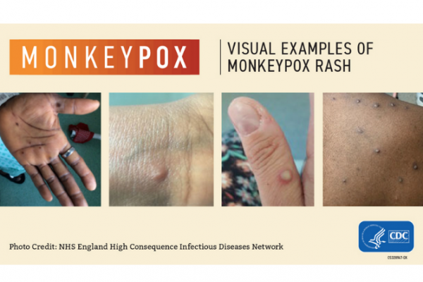 Images of monkeypox lesions