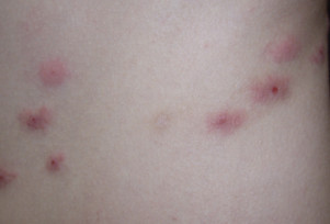 Insect bites on a child's skin becoming red and inflamed