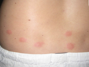 Insect bites on a child's lower back