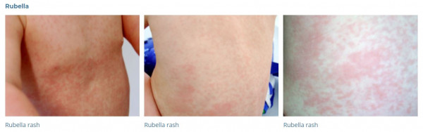 Photos of skin with rubella rash