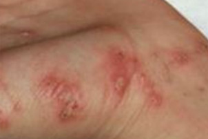 Scabies becoming worse on a child's skin