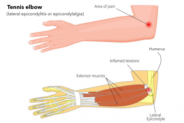 Elbow pain from carrying baby