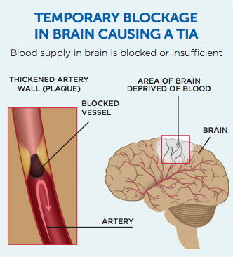 Graphic showing blocked blood supply in brain causing TIA