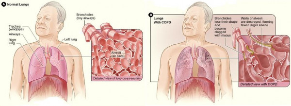 Illustration of healthy lungs and lungs with COPD and what happens to the airways