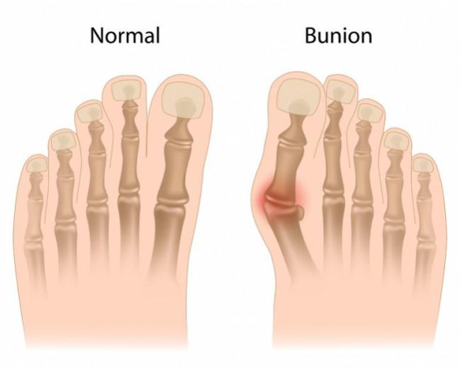 Comparison of foot with and without bunion