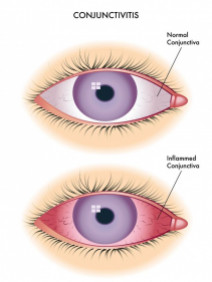 Image of inflamed conjunctiva