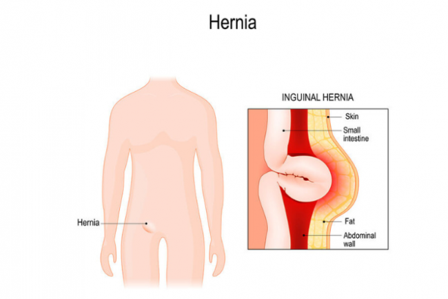 Hernia (abdominal)
