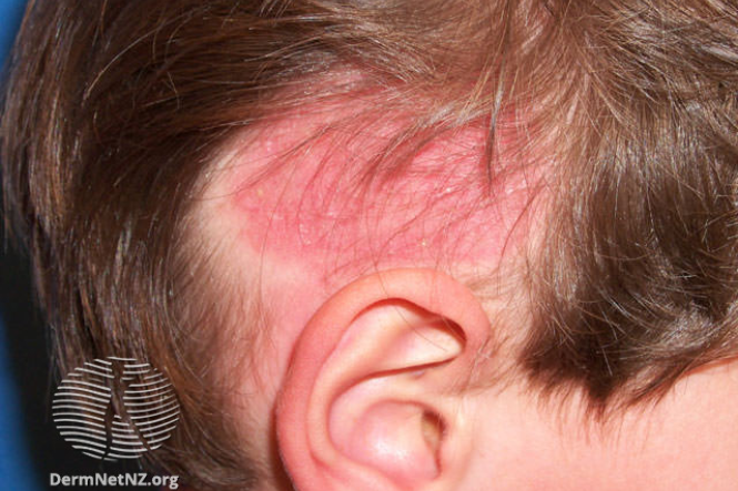 Alopecia Areata (AA) - Symptoms - familydoctor.org